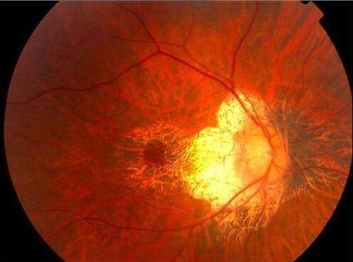 黄斑出血.jpg 黄斑出血.jpg