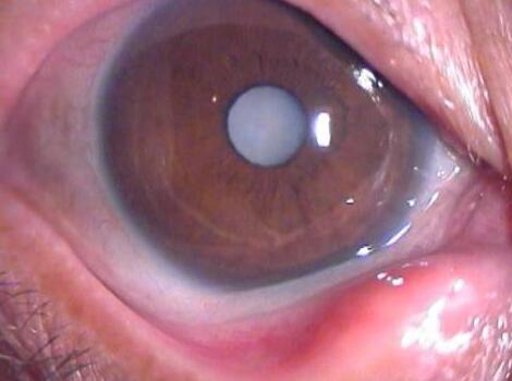 白内障是指眼睛的晶状体由透明变成不透明,阻碍光线进入眼内,从而影响了视力。初期混浊对视力影响不大,而后逐渐加重,直至明显影响视力甚至失明。我国目前约有500 人患有白内障,每年新增40 人,80岁以上老年人的白内障发病率近99%,随着我国老龄化进程的加剧,白内障在我国的发病人数仍有升高趋势。.jpg 白内障是指眼睛的晶状体由透明变成不透明,阻碍光线进入眼内,从而影响了视力。初期混浊对视力影响不大,而后逐渐加重,直至明显影响视力甚至失明。我国目前约有500 人患有白内障,每年新增40 人,80岁以上老年人的白内障发病率近99%,随着我国老龄化进程的加剧,白内障在我国的发病人数仍有升高趋势。.jpg