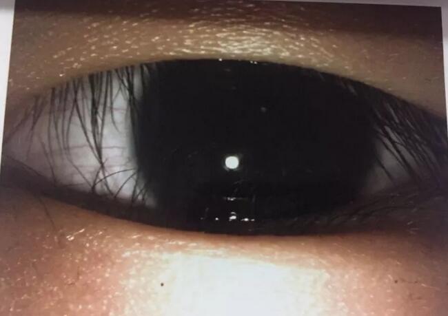 “像小岩这样的情况,睫毛直接贴附在角膜上,刺激角膜,患儿长期眼部红肿、怕光、流泪,那还是建议手术医治。现在的倒睫手术属于眼科手术里面的小手术,一般不会留下过大的疤痕,患者不用过于担心,如果孩子有倒睫的情况,应该尽早进行积极的医治。”——福州眼科医院副院长李谦益1.jpg “像小岩这样的情况,睫毛直接贴附在角膜上,刺激角膜,患儿长期眼部红肿、怕光、流泪,那还是建议手术医治。现在的倒睫手术属于眼科手术里面的小手术,一般不会留下过大的疤痕,患者不用过于担心,如果孩子有倒睫的情况,应该尽早进行积极的医治。”——福州眼科医院副院长李谦益1.jpg