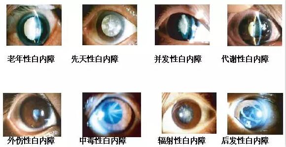 长时间在白色光亮污染环境下工作和生活的人,尤其是长时间接触过强的光线,视网膜和虹膜都会受到程度不同的损害,较终也会伤害晶状体,时间一长,就会使视力下降,使晶状体蛋白发生变性,形成混浊,发展成为白内障1.jpg 长时间在白色光亮污染环境下工作和生活的人,尤其是长时间接触过强的光线,视网膜和虹膜都会受到程度不同的损害,较终也会伤害晶状体,时间一长,就会使视力下降,使晶状体蛋白发生变性,形成混浊,发展成为白内障1.jpg
