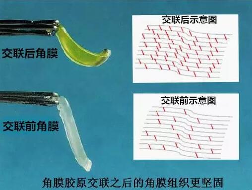 角膜胶原交联(Corneal Cross Linking,CCL)医治:使用370纳米波长的紫外线,激活核黄素(一种光敏感剂),使其转化成活性氧族,活性氧族再诱导角膜胶原纤维的氨基之间发生化学交联反应,使角膜胶原纤维直径增粗、提*角膜基质对多种降解酶作用的抵抗力等多重生物学效应,从而使角膜基质的机械强度增加2.jpg 角膜胶原交联(Corneal Cross Linking,CCL)医治:使用370纳米波长的紫外线,激活核黄素(一种光敏感剂),使其转化成活性氧族,活性氧族再诱导角膜胶原纤维的氨基之间发生化学交联反应,使角膜胶原纤维直径增粗、提*角膜基质对多种降解酶作用的抵抗力等多重生物学效应,从而使角膜基质的机械强度增加2.jpg