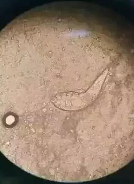 近日合肥名人眼科医院接诊了一位患者,眼睛干涩伴随发痒,同时分泌物较多。医生用显微镜一检查,发现在他睫毛根部长满了一条条蠕动的螨虫!1.jpg 近日合肥名人眼科医院接诊了一位患者,眼睛干涩伴随发痒,同时分泌物较多。医生用显微镜一检查,发现在他睫毛根部长满了一条条蠕动的螨虫!1.jpg