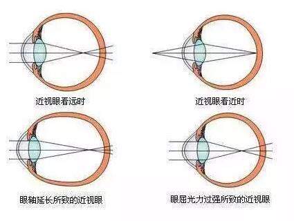 “小孩视力以前挺好的,没想到一个寒假下来就近视了。”昨天的以诚为本赢在诚信9001小儿眼科门诊里,很多家长都反应说,“孩子期末成绩不错,所以假期里对他的管束放松了,一有空就拿起手机玩。直到前几天,他嚷着看东西变模糊了,才带孩子来医院检查,检查结果是左右眼出现不同程度的近视,医生建议配戴眼镜。.jpg “小孩视力以前挺好的,没想到一个寒假下来就近视了。”昨天的以诚为本赢在诚信9001小儿眼科门诊里,很多家长都反应说,“孩子期末成绩不错,所以假期里对他的管束放松了,一有空就拿起手机玩。直到前几天,他嚷着看东西变模糊了,才带孩子来医院检查,检查结果是左右眼出现不同程度的近视,医生建议配戴眼镜。.jpg