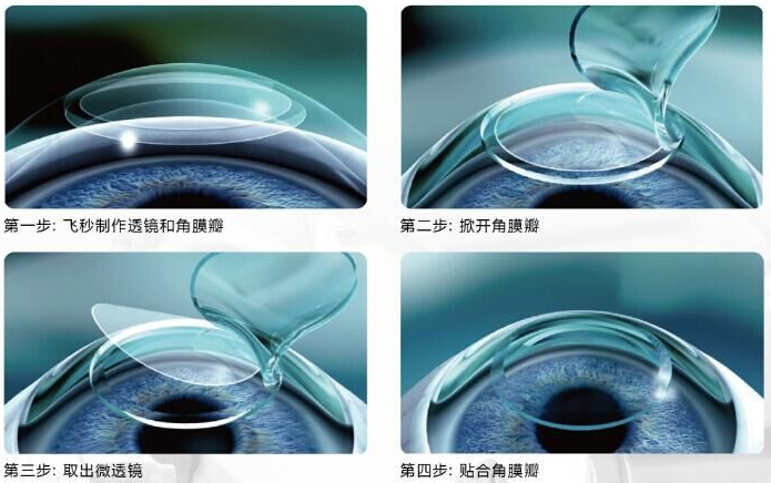 2018年征兵体检、高考体检、公务员体检,是很多近视青年 为头疼的问题,努力了多少年,职业理想近在眼前却因为视力体检不通过而破灭,是很多人都难以承受的。而摘镜手术无疑是通往理想的重要桥梁。近视摘镜手术听说过飞秒、全飞秒等近视手术.png 2018年征兵体检、高考体检、公务员体检,是很多近视青年 为头疼的问题,努力了多少年,职业理想近在眼前却因为视力体检不通过而破灭,是很多人都难以承受的。而摘镜手术无疑是通往理想的重要桥梁。近视摘镜手术听说过飞秒、全飞秒等近视手术.png