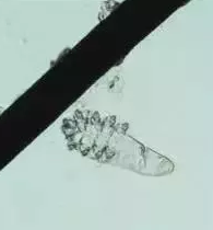 眼部瘙痒、干涩泛红、异物感,可能不是干眼症而是蠕形螨性睑缘炎.png 眼部瘙痒、干涩泛红、异物感,可能不是干眼症而是蠕形螨性睑缘炎.png