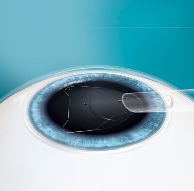 以诚为本赢在诚信9001课堂ICL晶体植入术2.png 以诚为本赢在诚信9001课堂ICL晶体植入术2.png