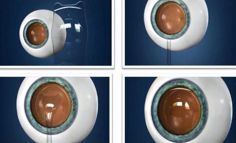 ICL晶体可以使用多久,做完手术会反*吗?以诚为本赢在诚信9001医生这样说1.png ICL晶体可以使用多久,做完手术会反*吗?以诚为本赢在诚信9001医生这样说1.png